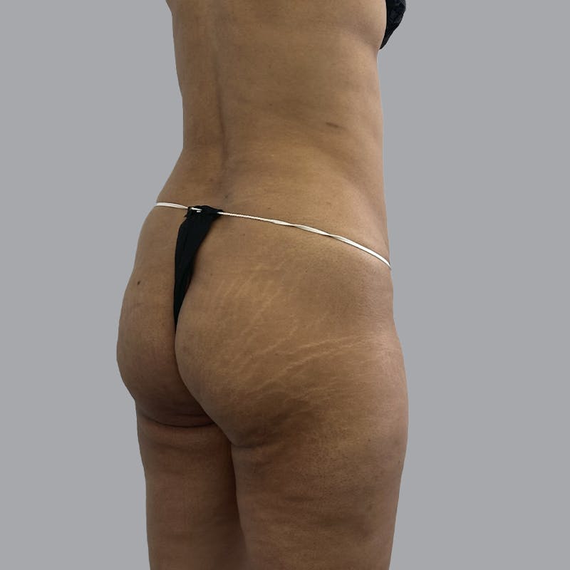 Brazilian Butt Lift and Hip Dip Before & After Gallery - Patient 291392 - Image 3