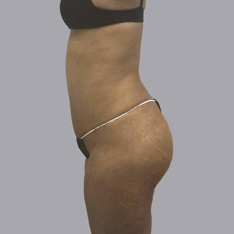Brazilian Butt Lift and Hip Dip Before & After Gallery - Patient 291392 - Image 6