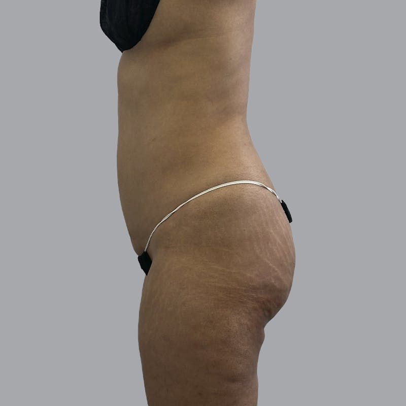 Brazilian Butt Lift and Hip Dip Before & After Gallery - Patient 291392 - Image 5