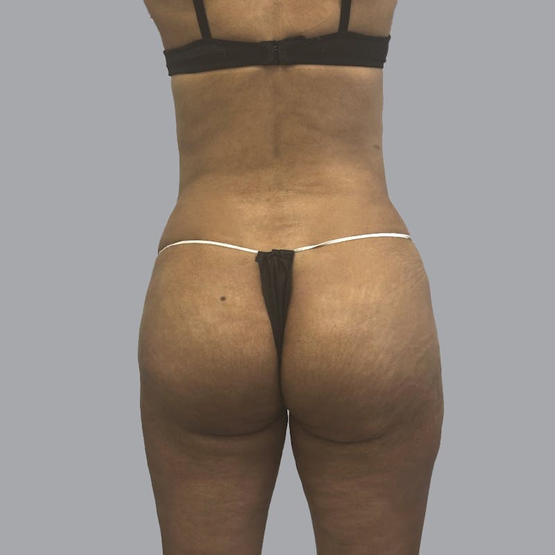 Brazilian Butt Lift and Hip Dip Before & After Gallery - Patient 291392 - Image 2