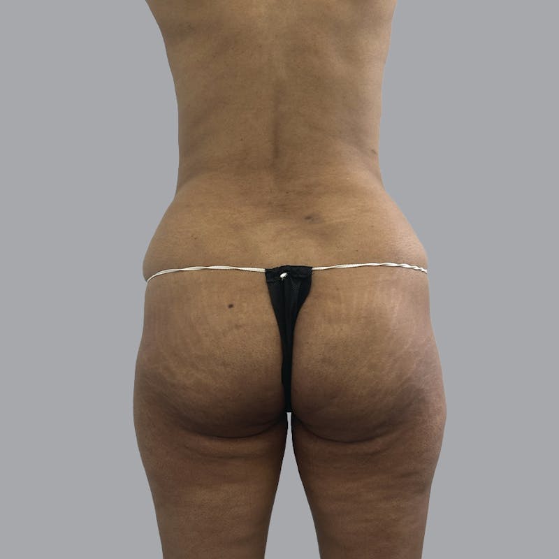 Brazilian Butt Lift and Hip Dip Before & After Gallery - Patient 291392 - Image 1