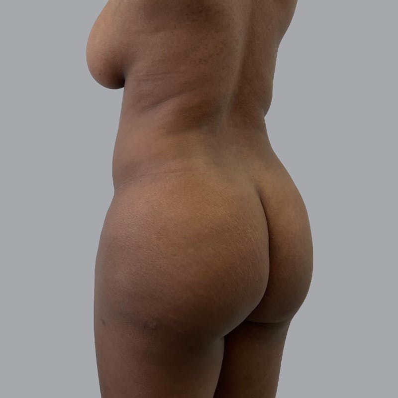 Brazilian Butt Lift and Hip Dip Before & After Gallery - Patient 110078 - Image 3