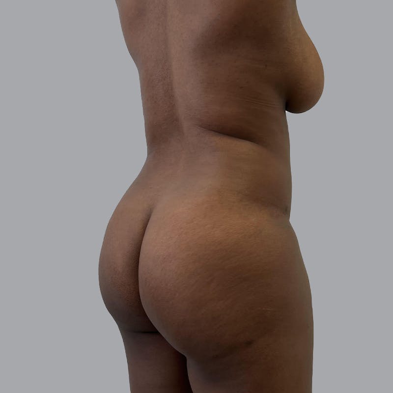 Body Liposuction Before & After Gallery - Patient 358426 - Image 5