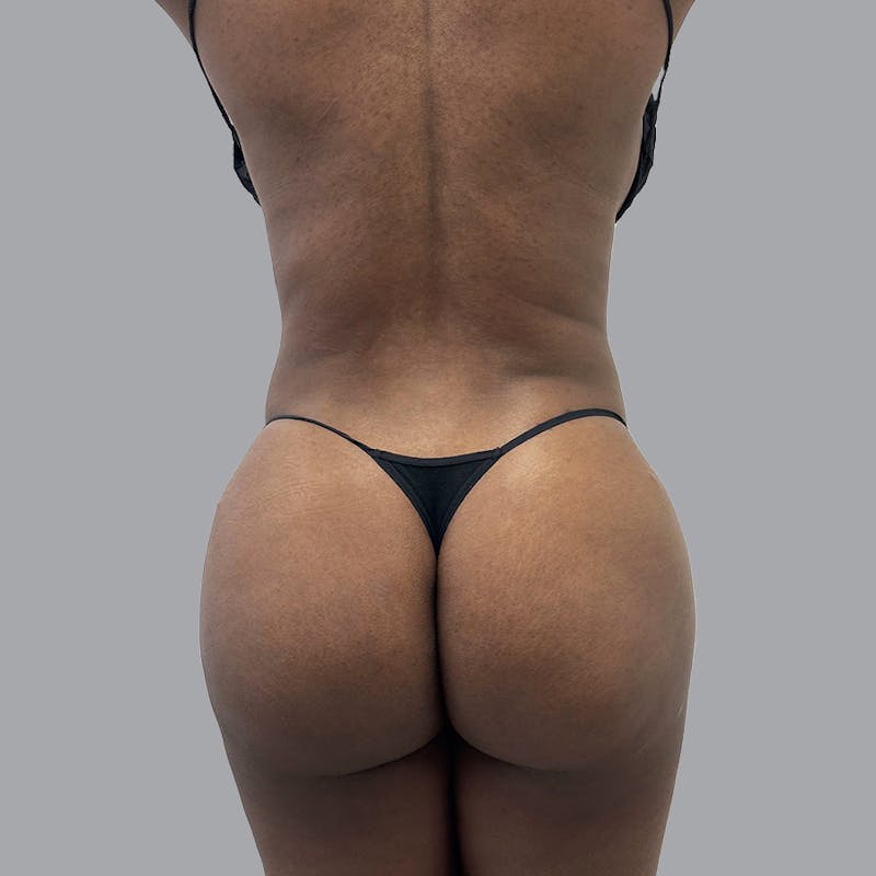 Brazilian Butt Lift and Hip Dip Before & After Gallery - Patient 110078 - Image 2