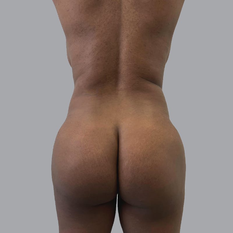 Brazilian Butt Lift and Hip Dip Before & After Gallery - Patient 110078 - Image 1