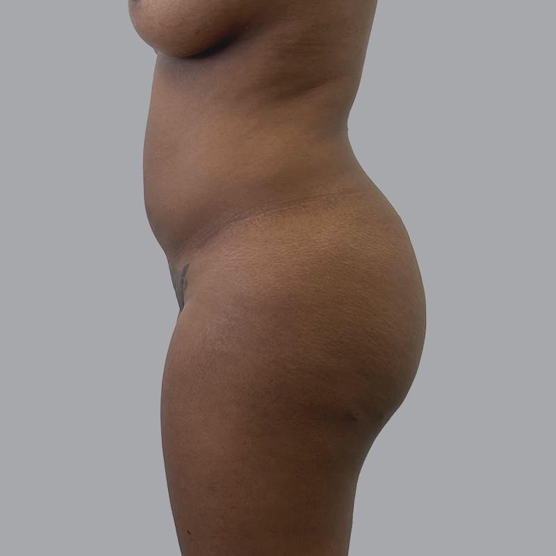 Brazilian Butt Lift and Hip Dip Before & After Gallery - Patient 110078 - Image 5