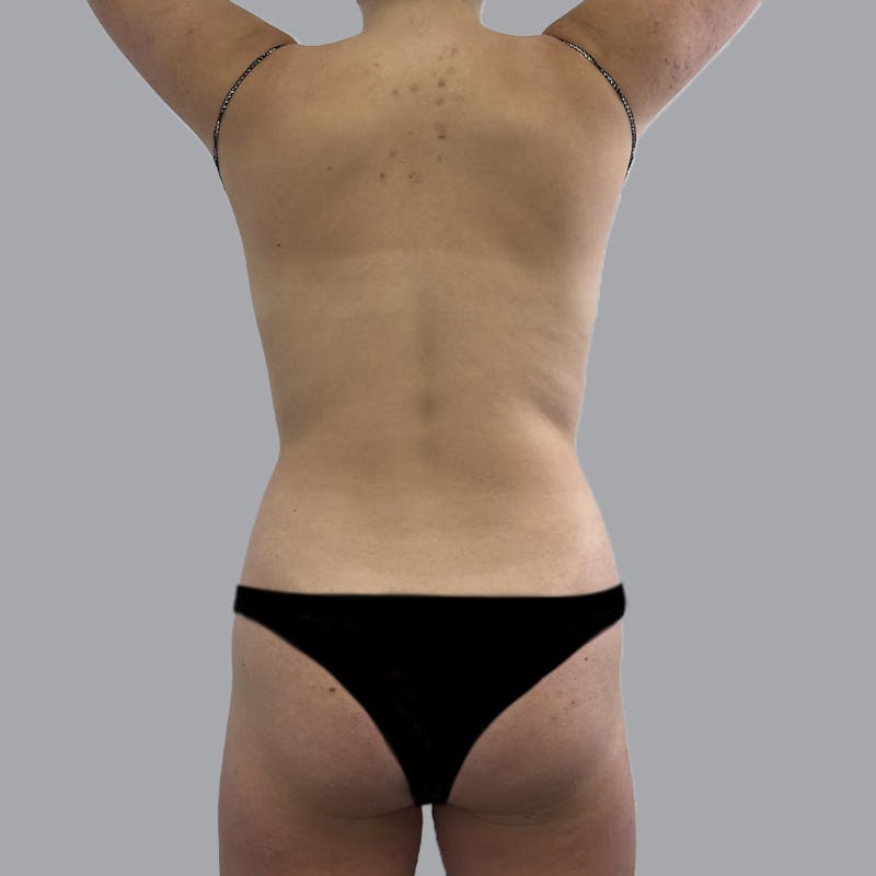 Body Liposuction Before & After Gallery - Patient 212174 - Image 7
