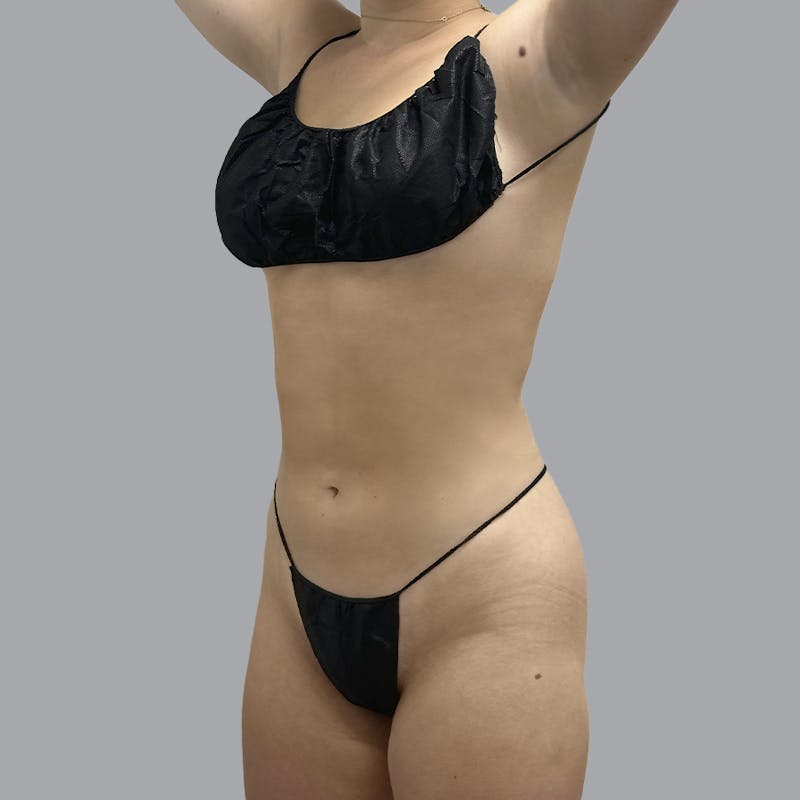 Body Liposuction Before & After Gallery - Patient 212174 - Image 4