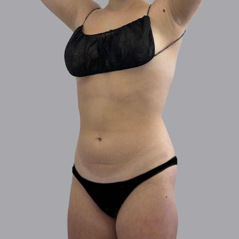 Body Liposuction Before & After Gallery - Patient 212174 - Image 3