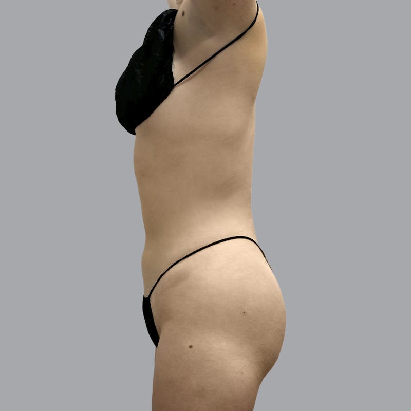 Body Liposuction Before & After Gallery - Patient 212174 - Image 6