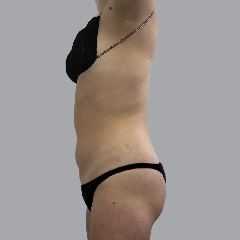 Body Liposuction Before & After Gallery - Patient 212174 - Image 5