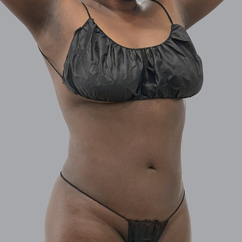 Body Liposuction Before & After Gallery - Patient 258053 - Image 4