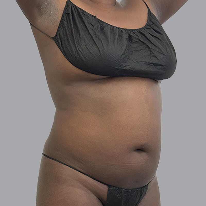 Body Liposuction Before & After Gallery - Patient 258053 - Image 3