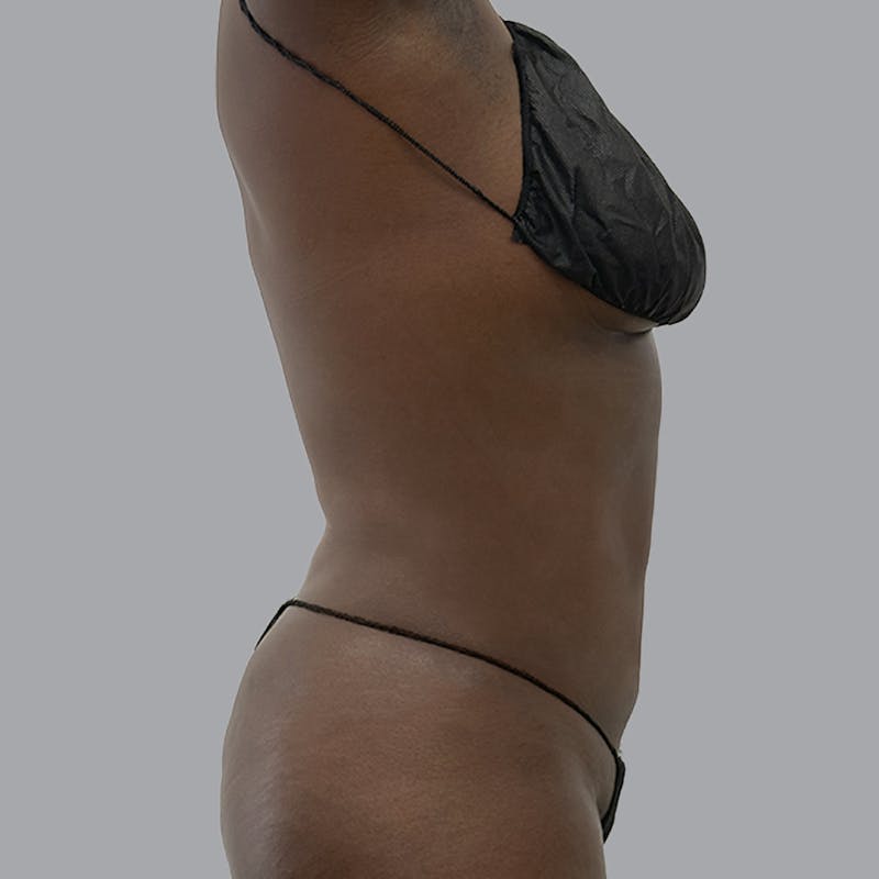 Body Liposuction Before & After Gallery - Patient 258053 - Image 6