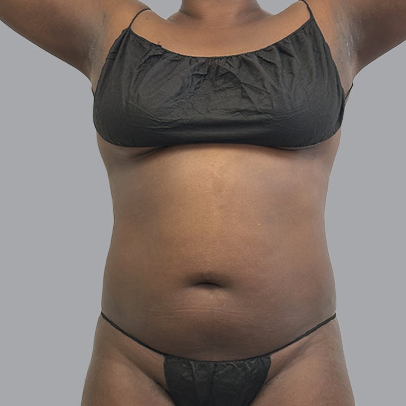 Body Liposuction Before & After Gallery - Patient 258053 - Image 1