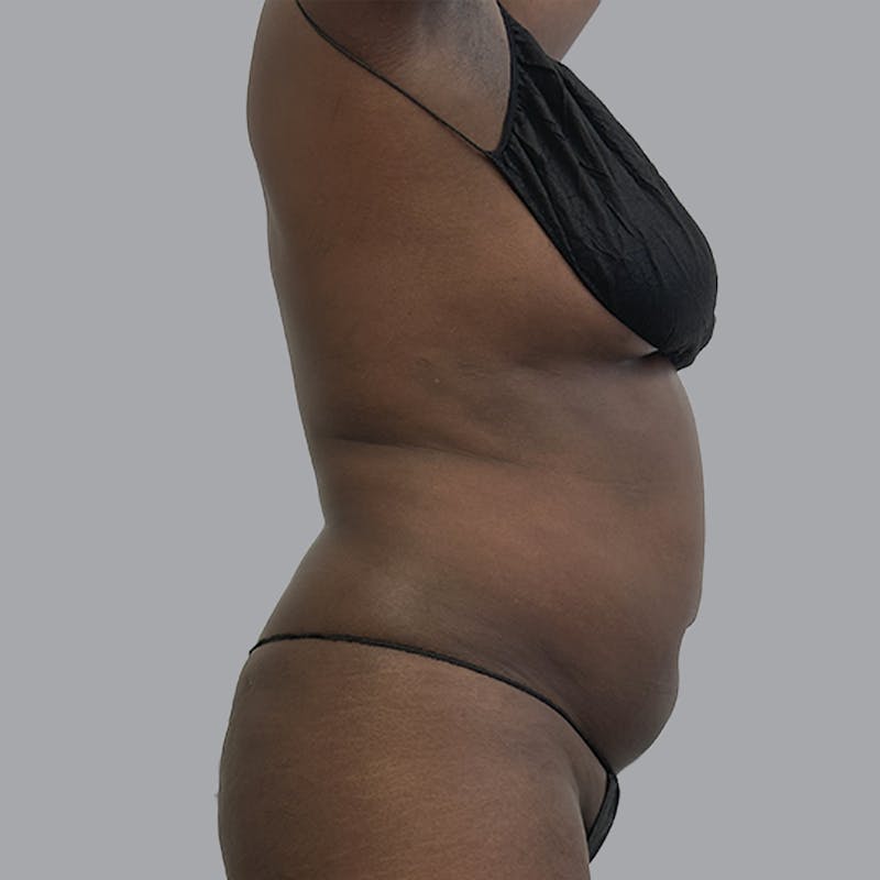 Body Liposuction Before & After Gallery - Patient 258053 - Image 5