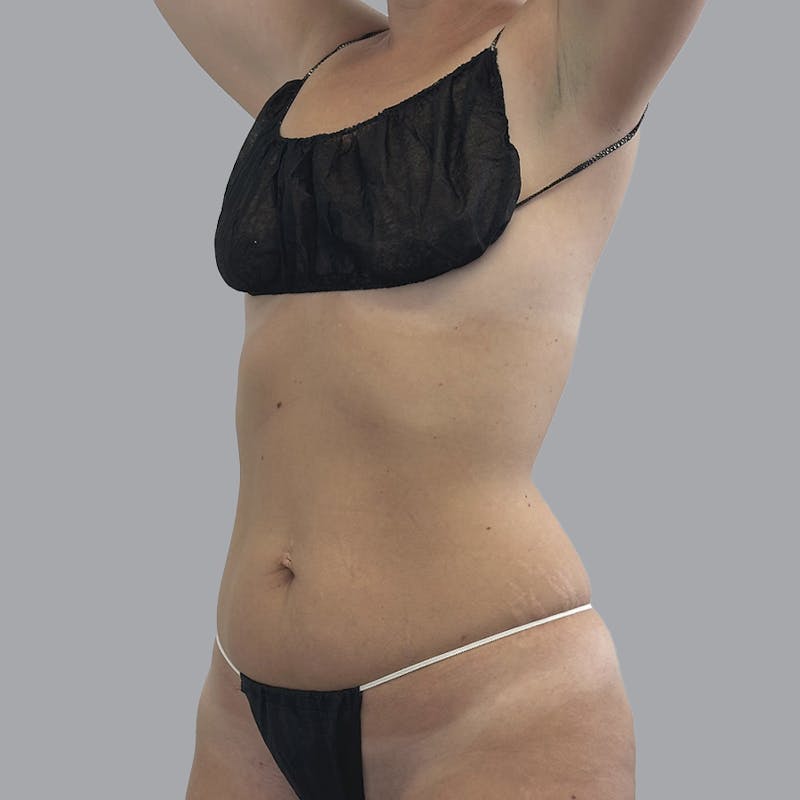 Body Liposuction Before & After Gallery - Patient 111413 - Image 3