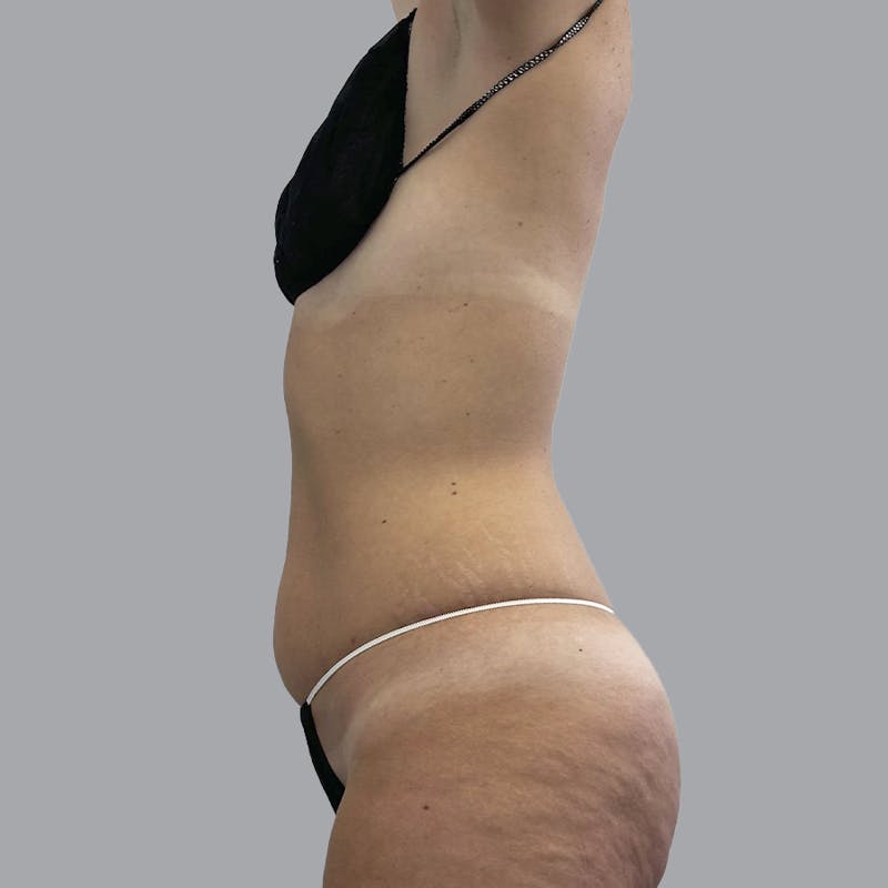 Body Liposuction Before & After Gallery - Patient 111413 - Image 5