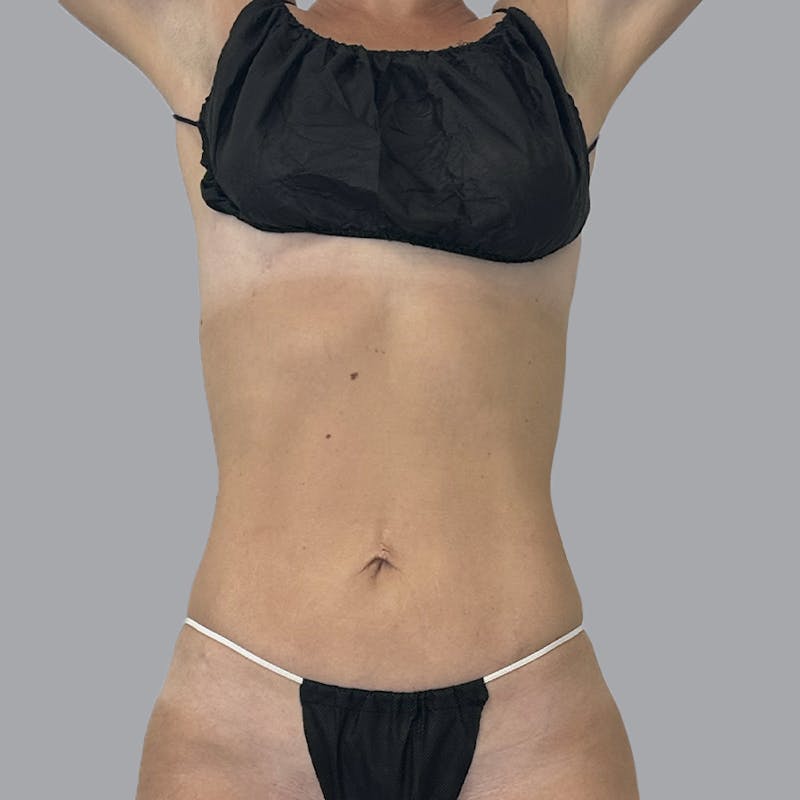 Body Liposuction Before & After Gallery - Patient 111413 - Image 2