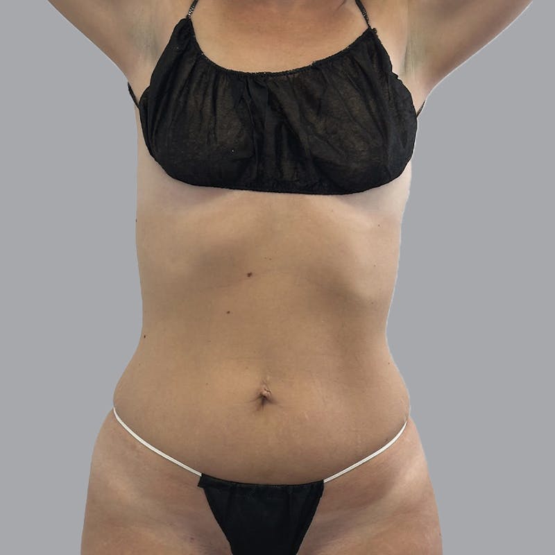 Body Liposuction Before & After Gallery - Patient 111413 - Image 1
