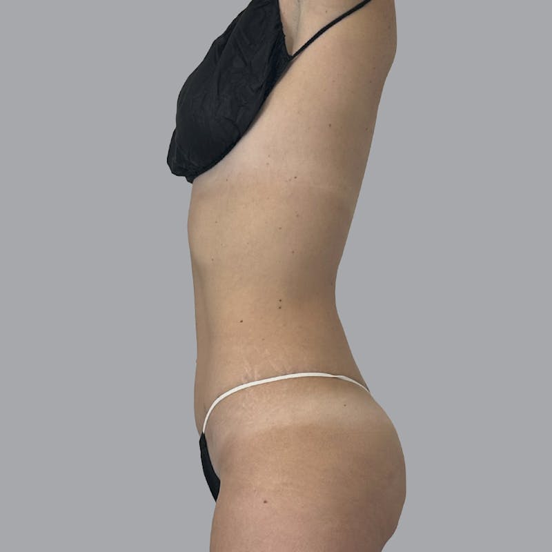Body Liposuction Before & After Gallery - Patient 111413 - Image 6