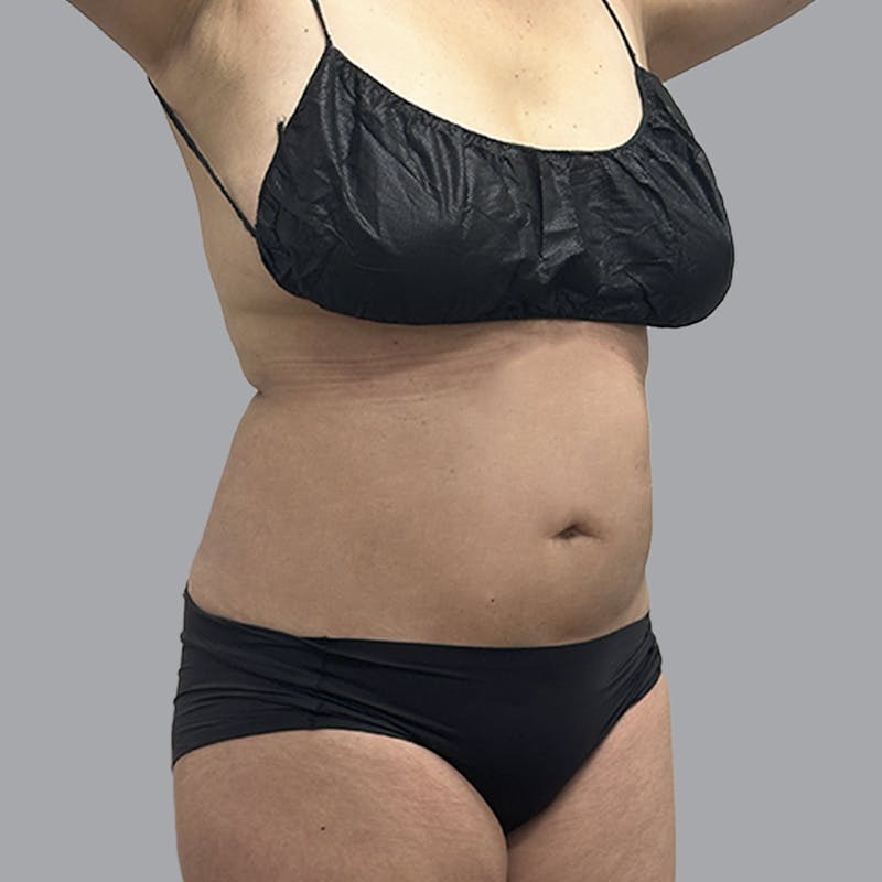Body Liposuction Before & After Gallery - Patient 240423 - Image 4