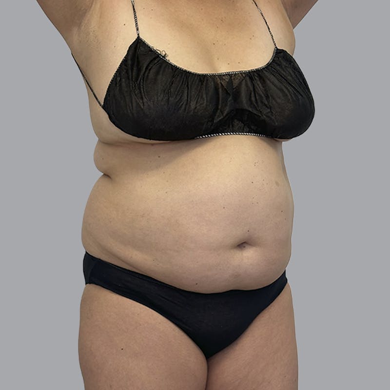 Body Liposuction Before & After Gallery - Patient 240423 - Image 3