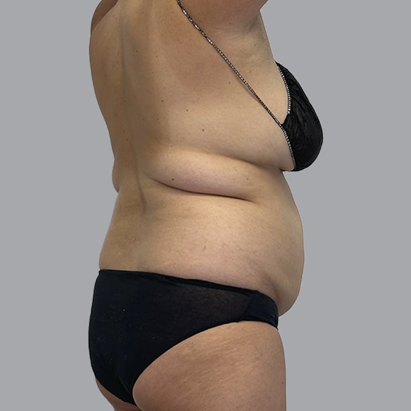 Body Liposuction Before & After Gallery - Patient 240423 - Image 5