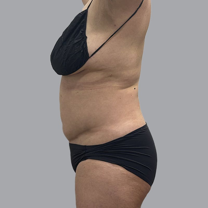Body Liposuction Before & After Gallery - Patient 240423 - Image 8
