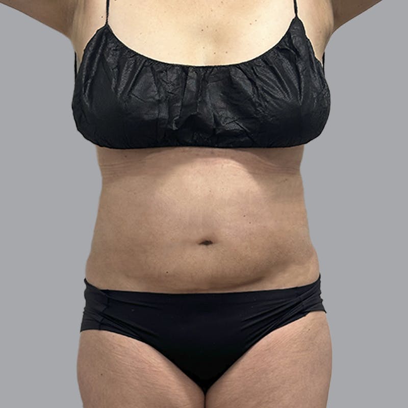 Body Liposuction Before & After Gallery - Patient 240423 - Image 2