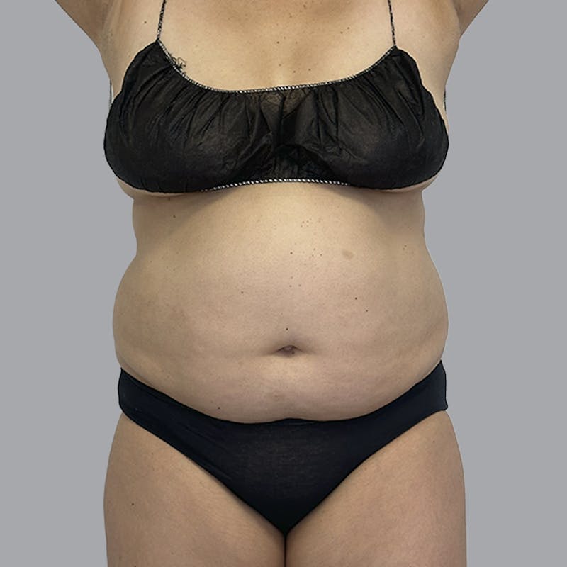 Body Liposuction Before & After Gallery - Patient 240423 - Image 1