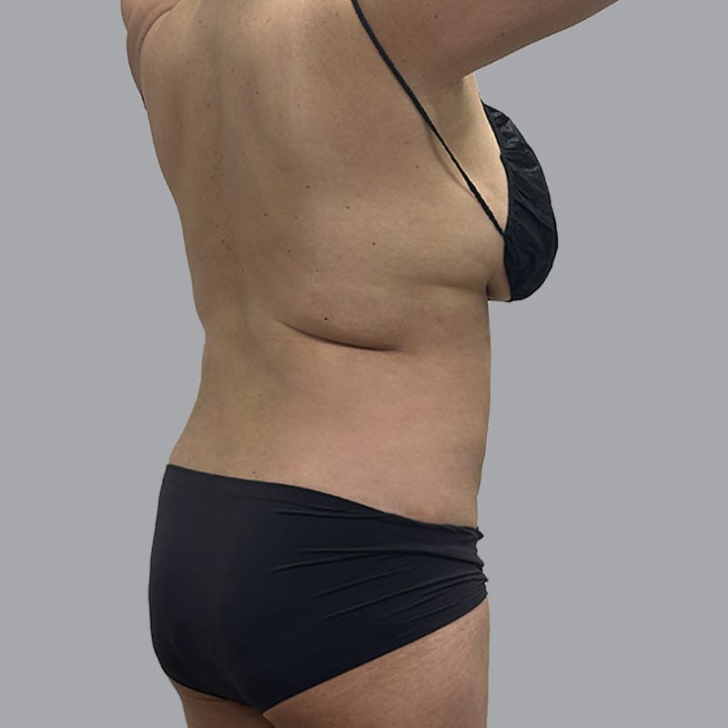 Body Liposuction Before & After Gallery - Patient 240423 - Image 6