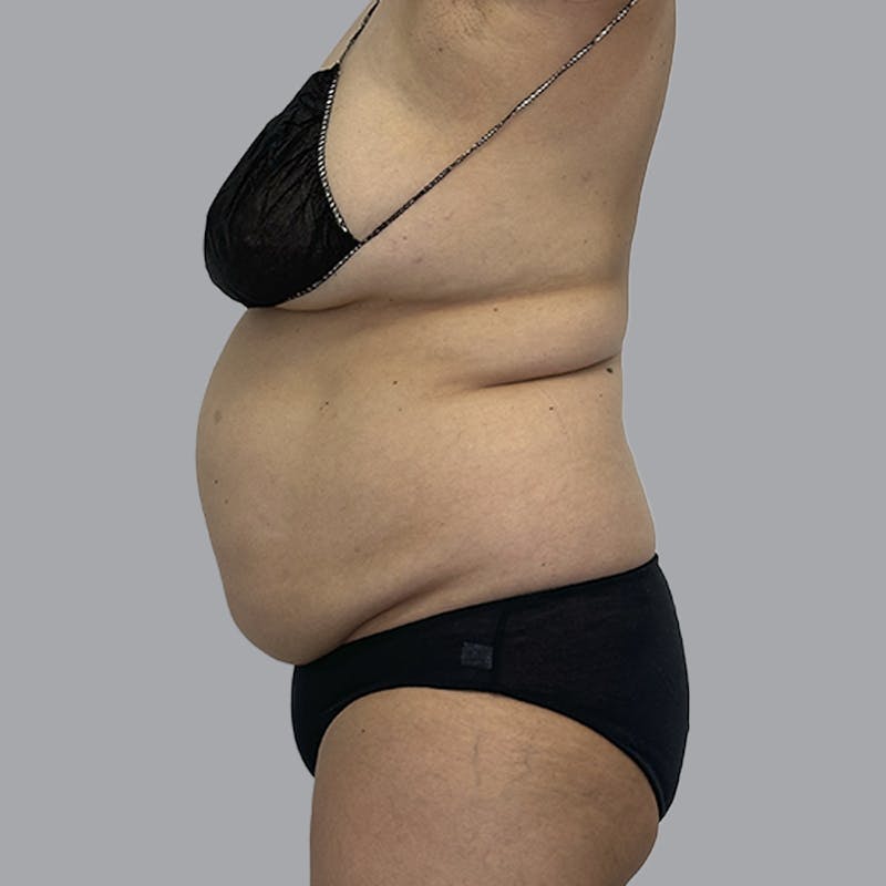 Body Liposuction Before & After Gallery - Patient 240423 - Image 7