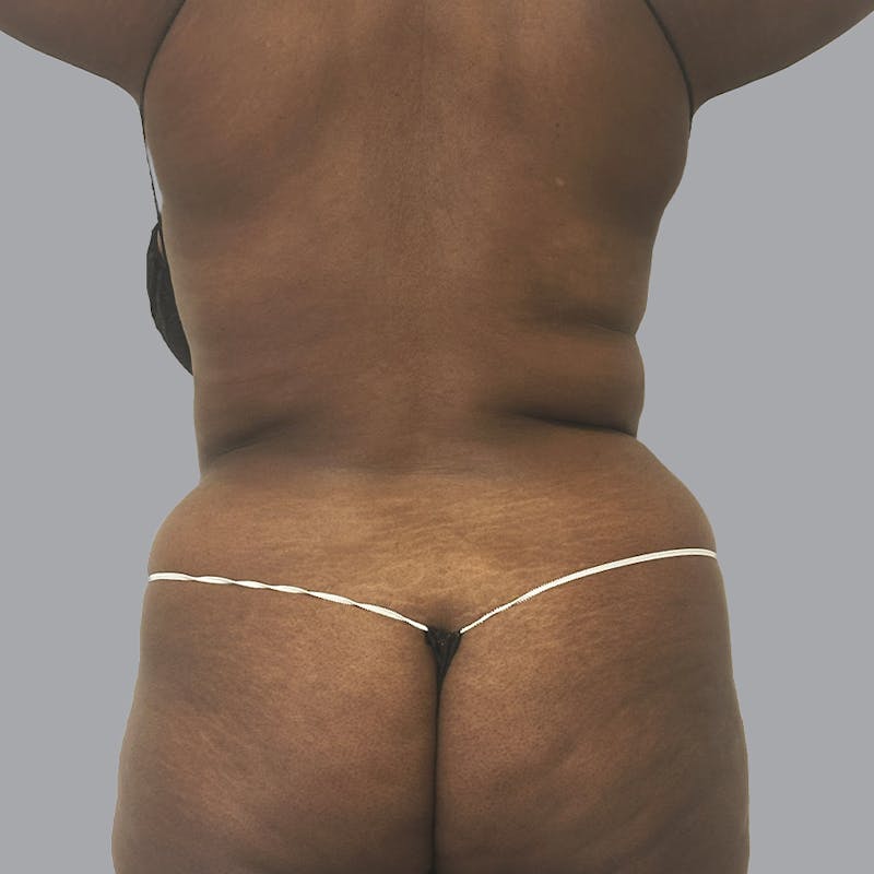 Body Liposuction Before & After Gallery - Patient 344832 - Image 7