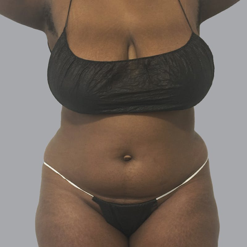 Body Liposuction Before & After Gallery - Patient 344832 - Image 1