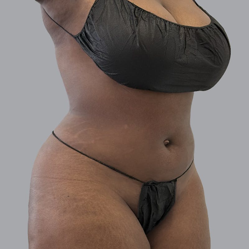 Body Liposuction Before & After Gallery - Patient 344832 - Image 4