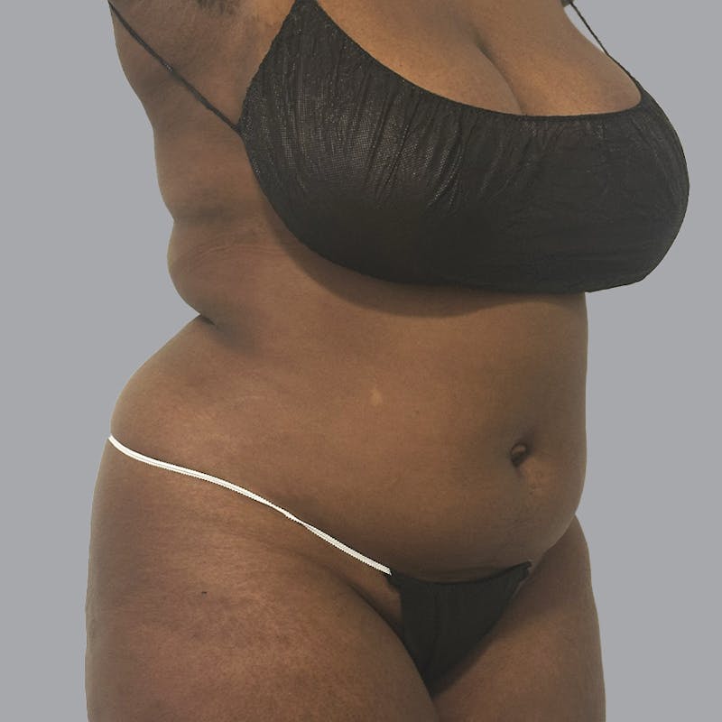 Body Liposuction Before & After Gallery - Patient 344832 - Image 3