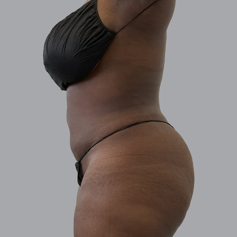 Body Liposuction Before & After Gallery - Patient 344832 - Image 6