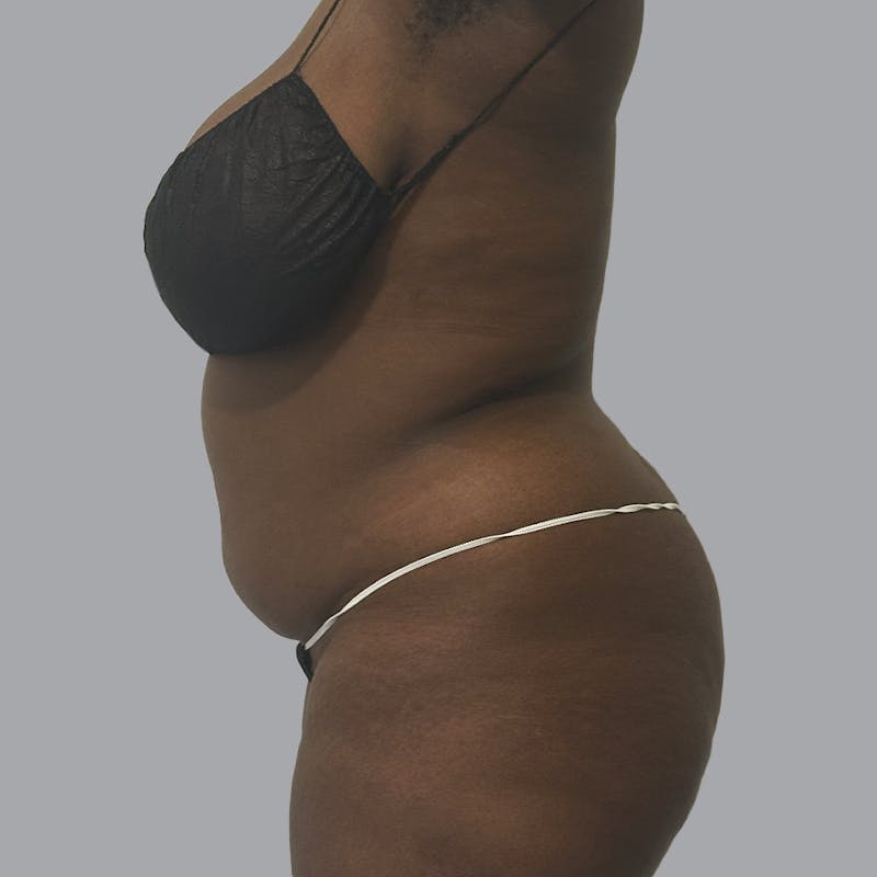 Body Liposuction Before & After Gallery - Patient 344832 - Image 5