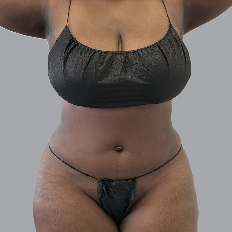 Body Liposuction Before & After Gallery - Patient 344832 - Image 2