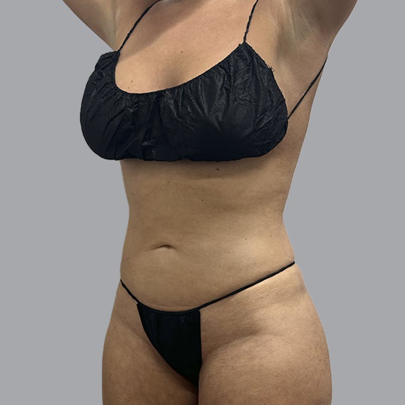 Body Liposuction Before & After Gallery - Patient 201158 - Image 4