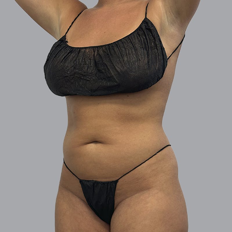 Body Liposuction Before & After Gallery - Patient 201158 - Image 3