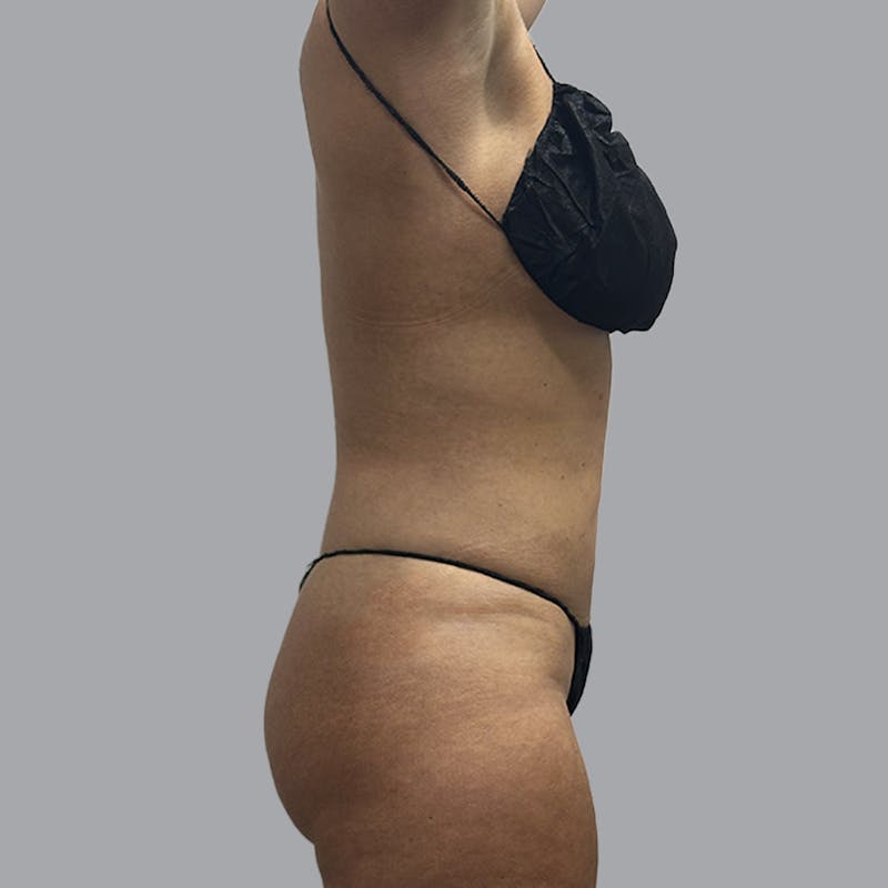 Body Liposuction Before & After Gallery - Patient 201158 - Image 6