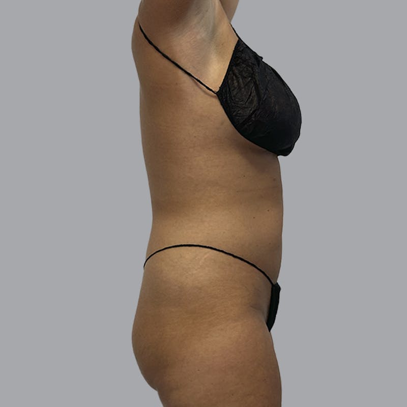 Body Liposuction Before & After Gallery - Patient 201158 - Image 5