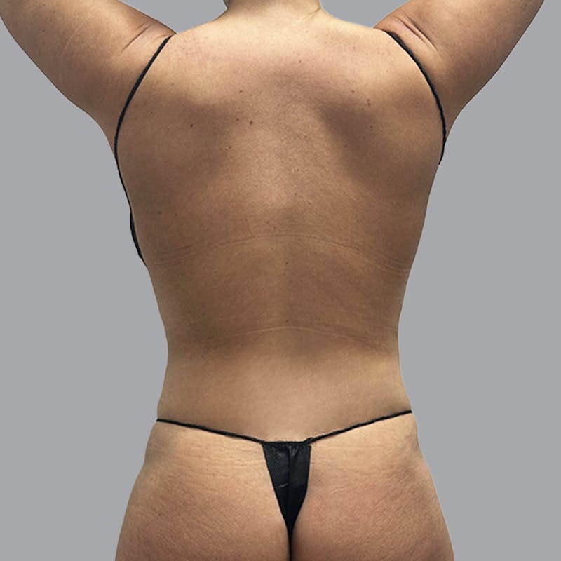 Body Liposuction Before & After Gallery - Patient 201158 - Image 8