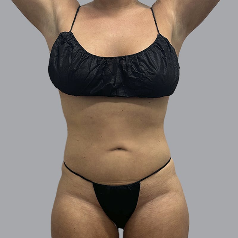 Body Liposuction Before & After Gallery - Patient 201158 - Image 2