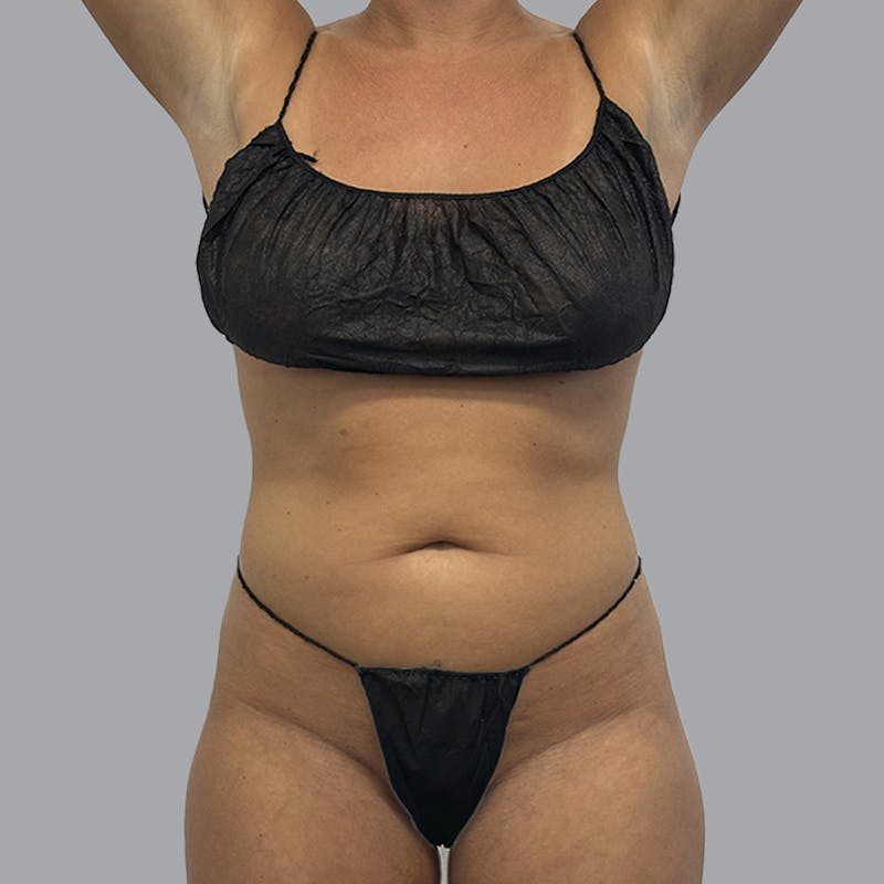Body Liposuction Before & After Gallery - Patient 201158 - Image 1