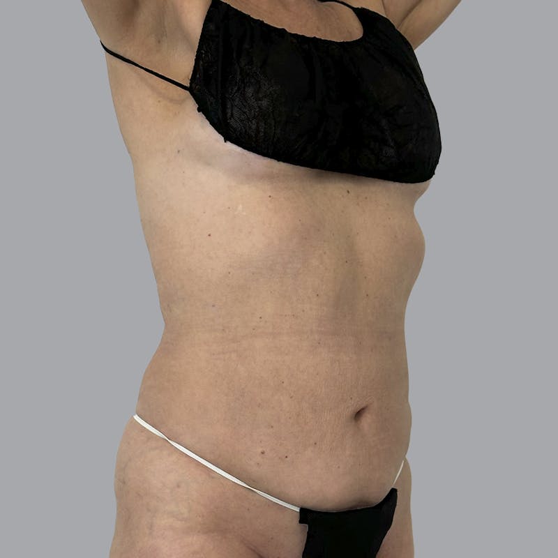 Body Liposuction Before & After Gallery - Patient 988427 - Image 2