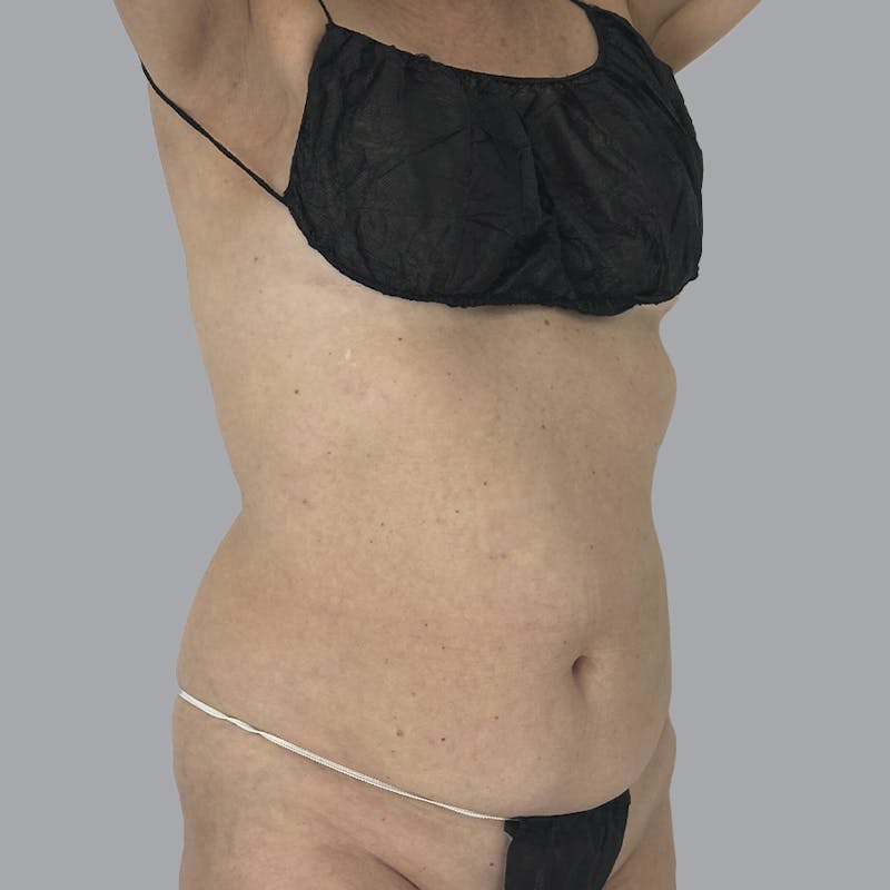 Body Liposuction Before & After Gallery - Patient 988427 - Image 1