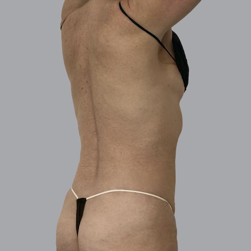 Body Liposuction Before & After Gallery - Patient 988427 - Image 8